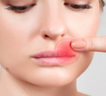 הרפס בשפתיים: מניעה וטיפול-תמונה